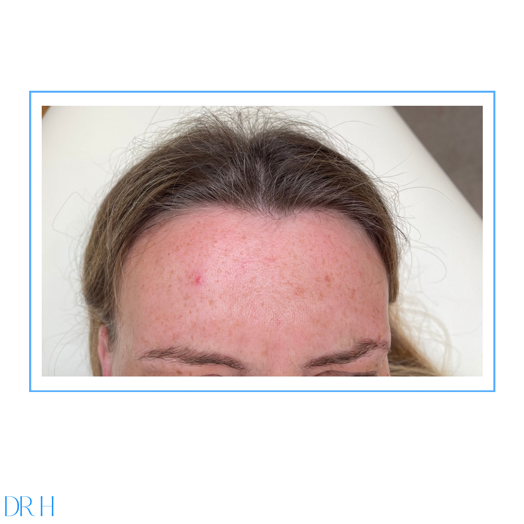 Anti-wrinkle injections to the forehead