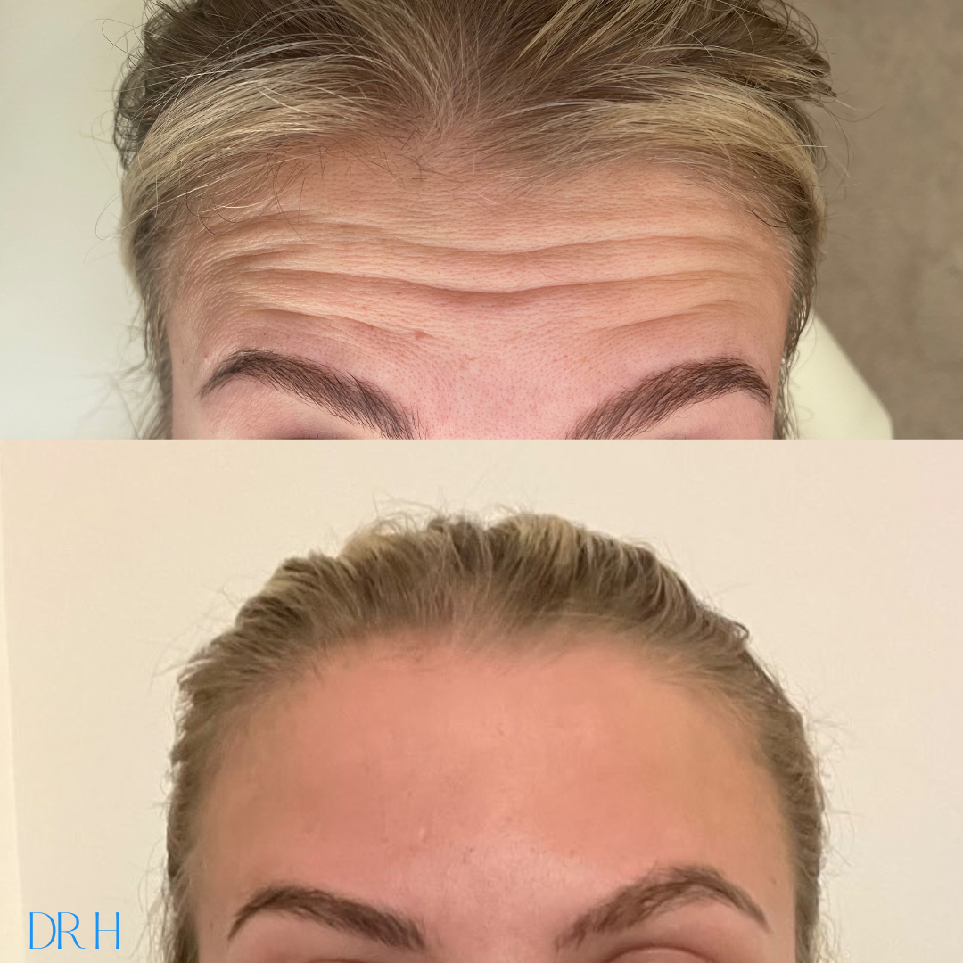 Anti-wrinkle injections to the forehead