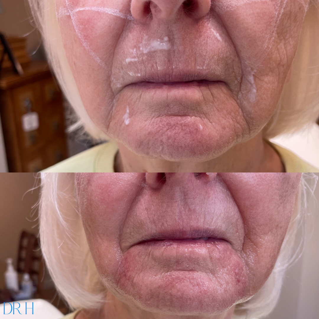 Juvaderm filler into the marionette lines