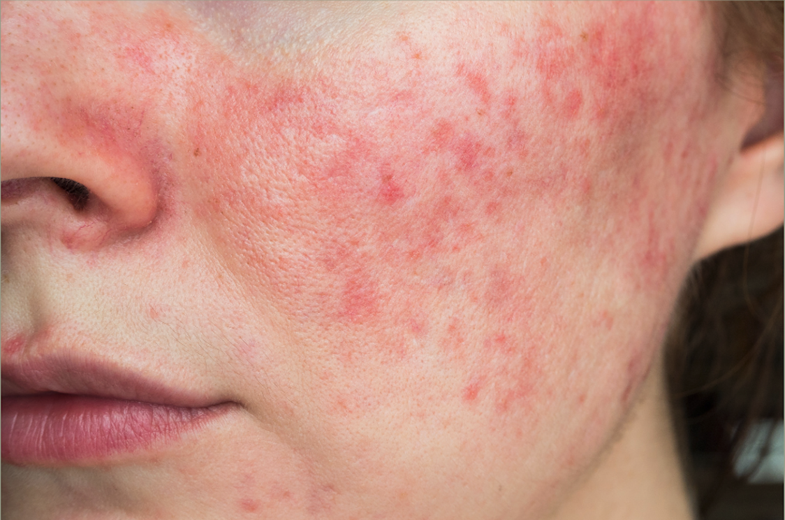 Rosacea 101: How to Recognize and Manage It