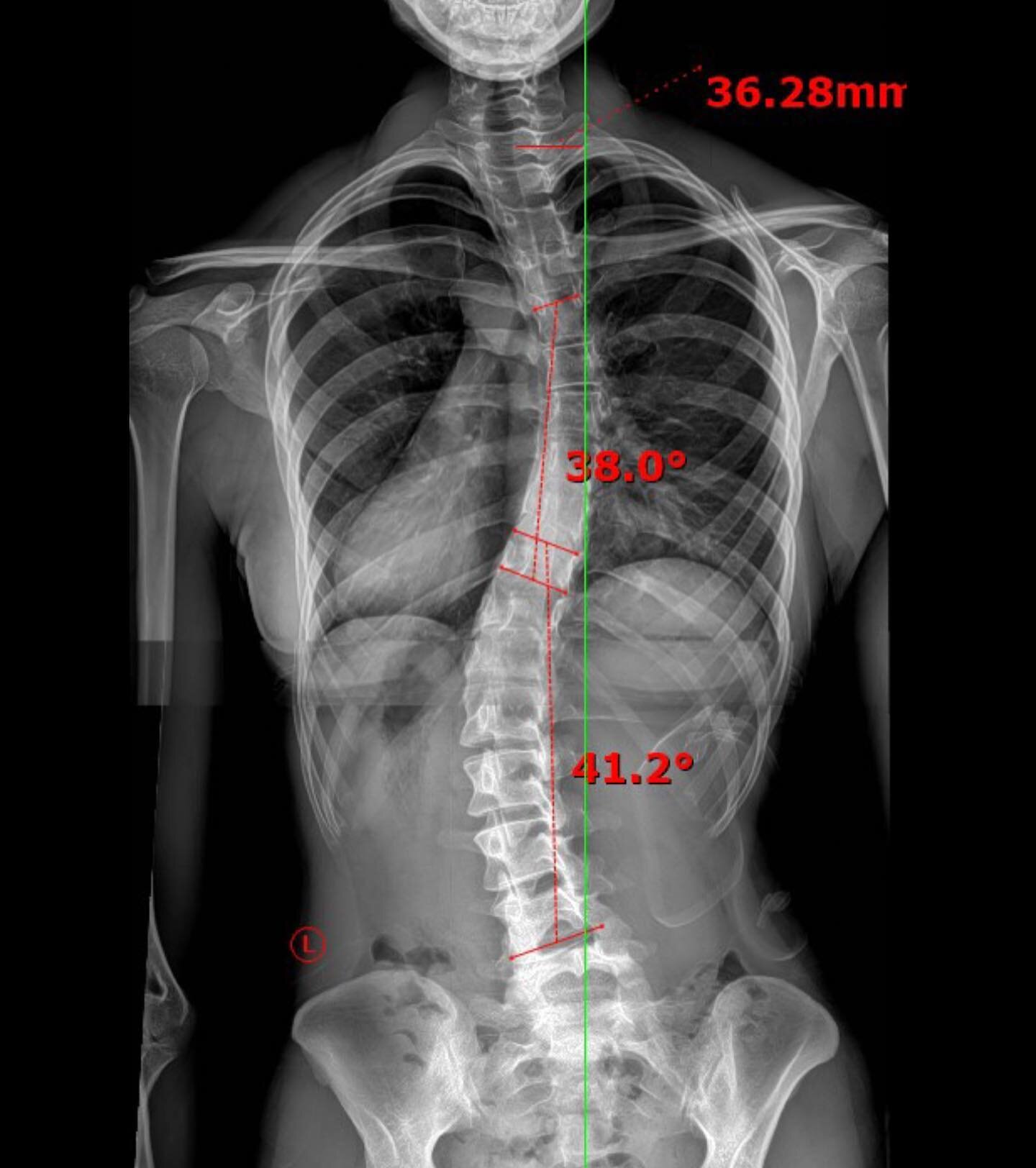 Check out one of our recent scoliosis patients! 

This patient was diagnosed with scoliosis at 13 and was recommended surgery to straighten the curve. 10 years later after refusing the surgery, and she started to have symptoms. The first x-ray is at 
