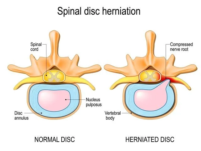 Disc Bulge vs. Disc Herniation