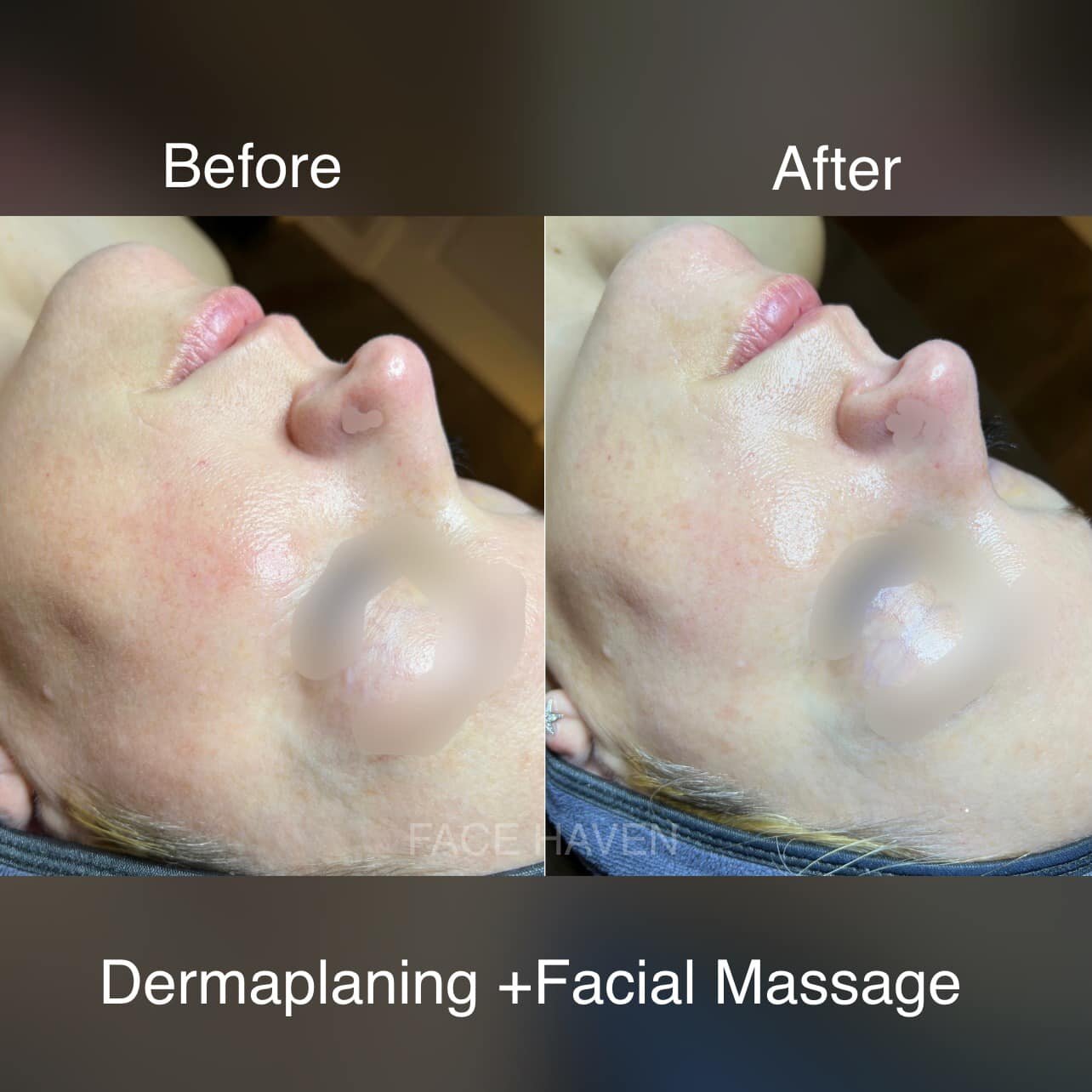 ✨Benefits of Dermaplaning✨
✅ Your skin look brighter, smoother, and glowing
✅ Skincare products penetrate the skin more effectively
✅ It smooths out fine lines and wrinkles.
✅ It reduces the appearance of acne scars.
✅ Your foundation applies more sm