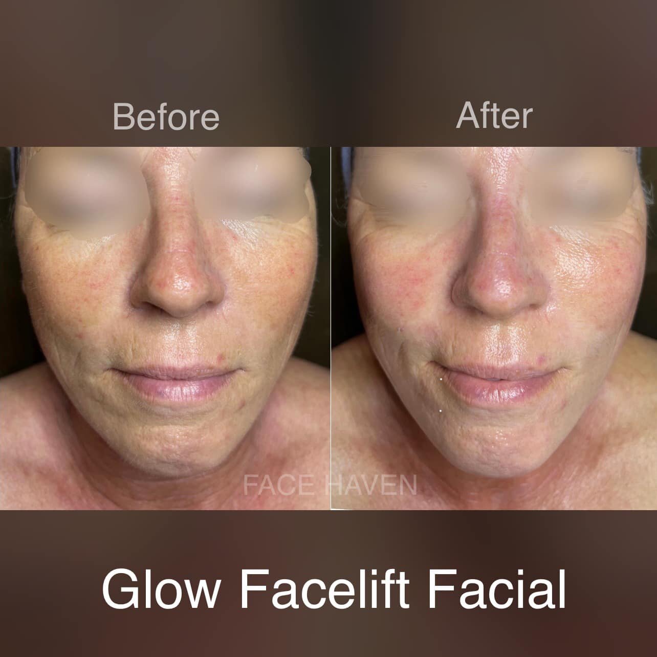 Glow Facelift Facial is our most popular treatment at Face Haven. It&rsquo;s combined with our one of a kind Facelift facial and Dermaplaning.
Our Facelift Massage loosens, trains and stimulates the facial muscles. It boosts collagen production, prom