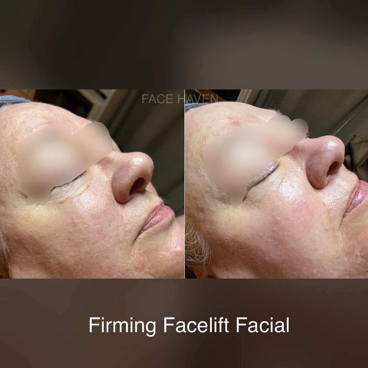 V-lifting mask is a popular treatment in South Korea that dramatically lift, tighten, and define facial contours, while brightening skin for an immediate glow. Wrinkle-erasing acetyl hexapeptide (known as botox effect), hydrolyzed collagen, copper pe