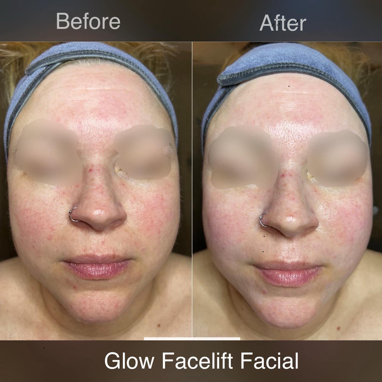Glow Facelift Facial is our most popular treatment at Face Haven. It&rsquo;s combined with our one of a kind Facelift facial and Dermaplaning.
Our Facelift Massage loosens, trains and stimulates the facial muscles. It boosts collagen production, prom