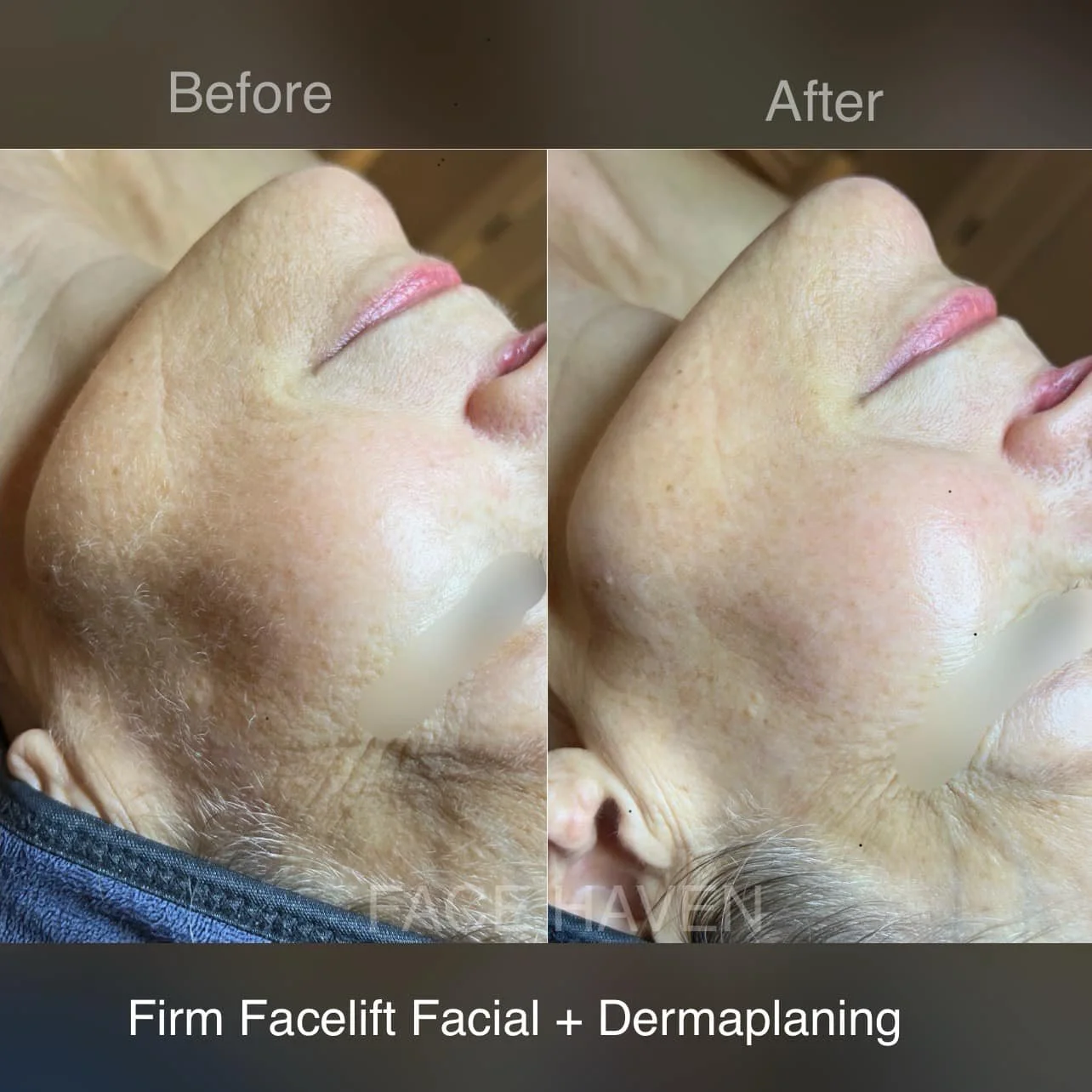 V-lifting mask is a popular treatment in South Korea that dramatically lift, tighten, and define facial contours, while brightening skin for an immediate glow. Wrinkle-erasing acetyl hexapeptide (known as botox effect), hydrolyzed collagen, copper pe