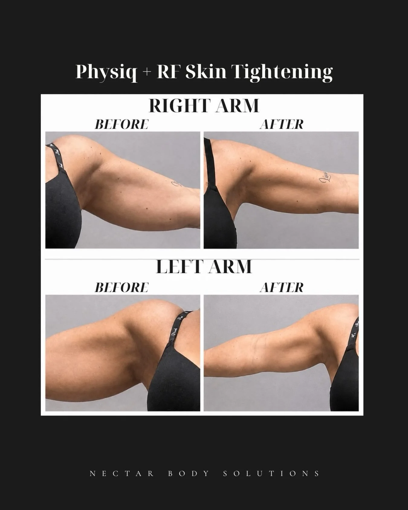 ✨ 5 WEEKS. REAL RESULTS. ✨
This skin transformation features PHYSIQ + RF Skin Tightening&mdash;a powerful combination designed to sculpt, tone, and tighten. 🤍

Ready to work toward your own sculpted results?

Use code SCULPTEDBYLUCIA for 30% OFF you
