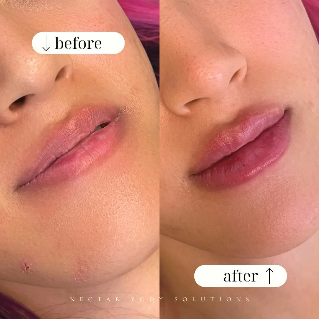 💋 Before &amp; After: Lip Filler
Using Versa, we enhanced the lips with added height + volume to create a soft, pouty look while keeping the overall shape beautifully balanced. ✨
A little volume, a lot of pout. 💉💋
Ready for your lip transformation
