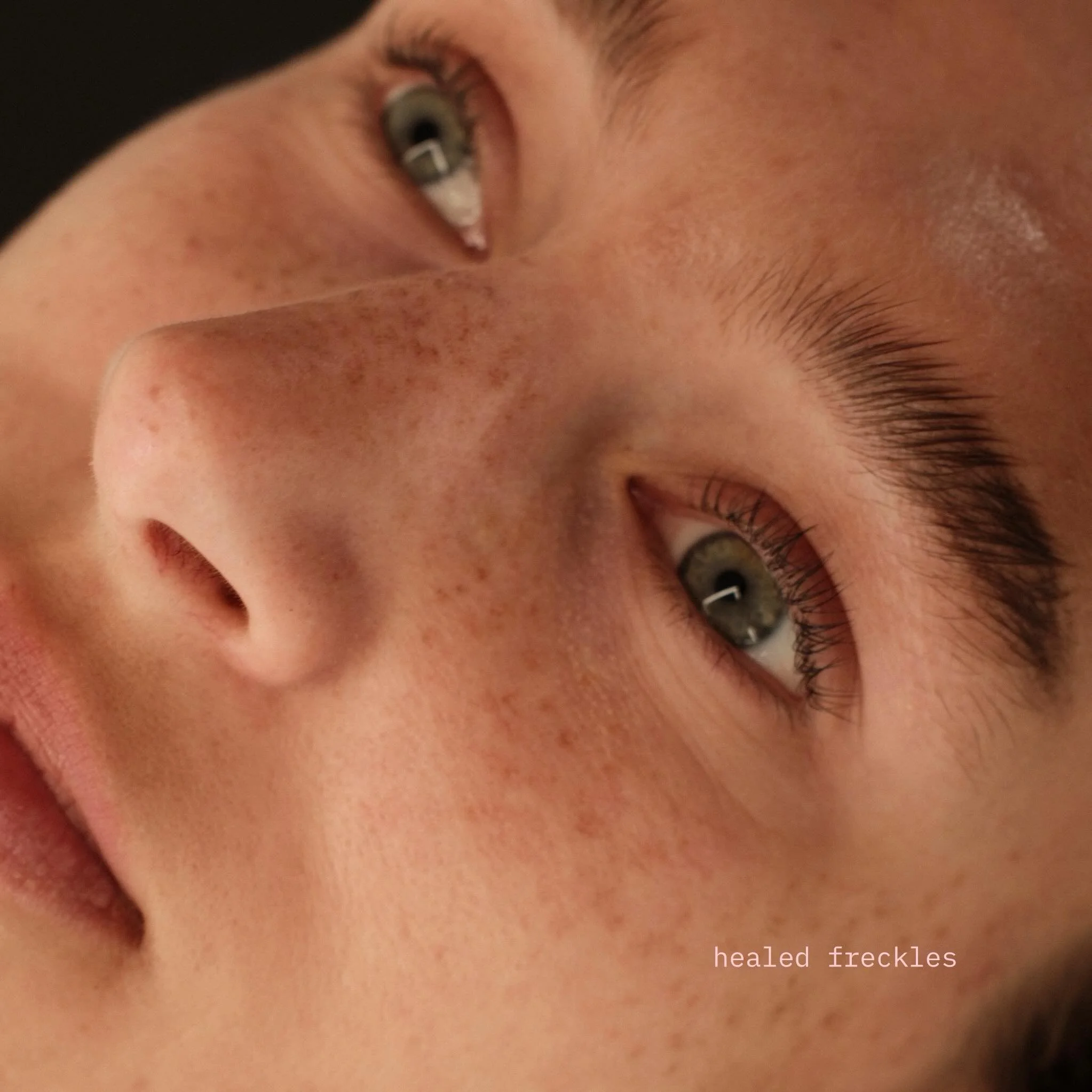 healed Freckles.