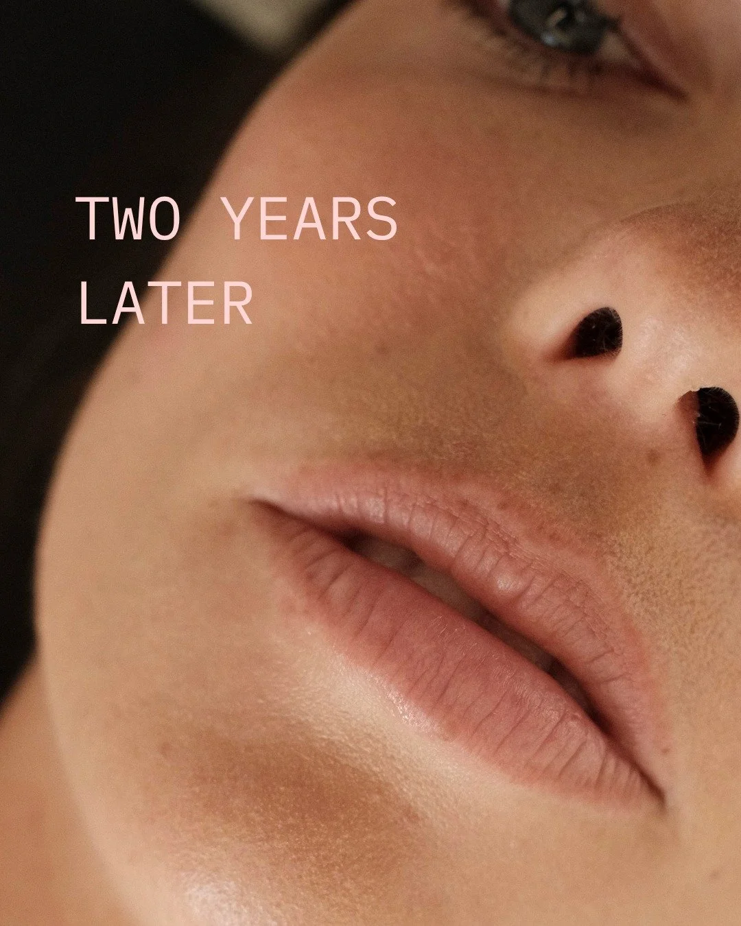 Two years later.

Ein Lip Blush bleibt nicht f&uuml;r immer so, wie es direkt nach der Behandlung aussieht. Die Farbe wird mit der Zeit heller und verblasst nach und nach.

Nach zwei Jahren war hier ein guter Zeitpunkt f&uuml;r einen Refresher: Die v
