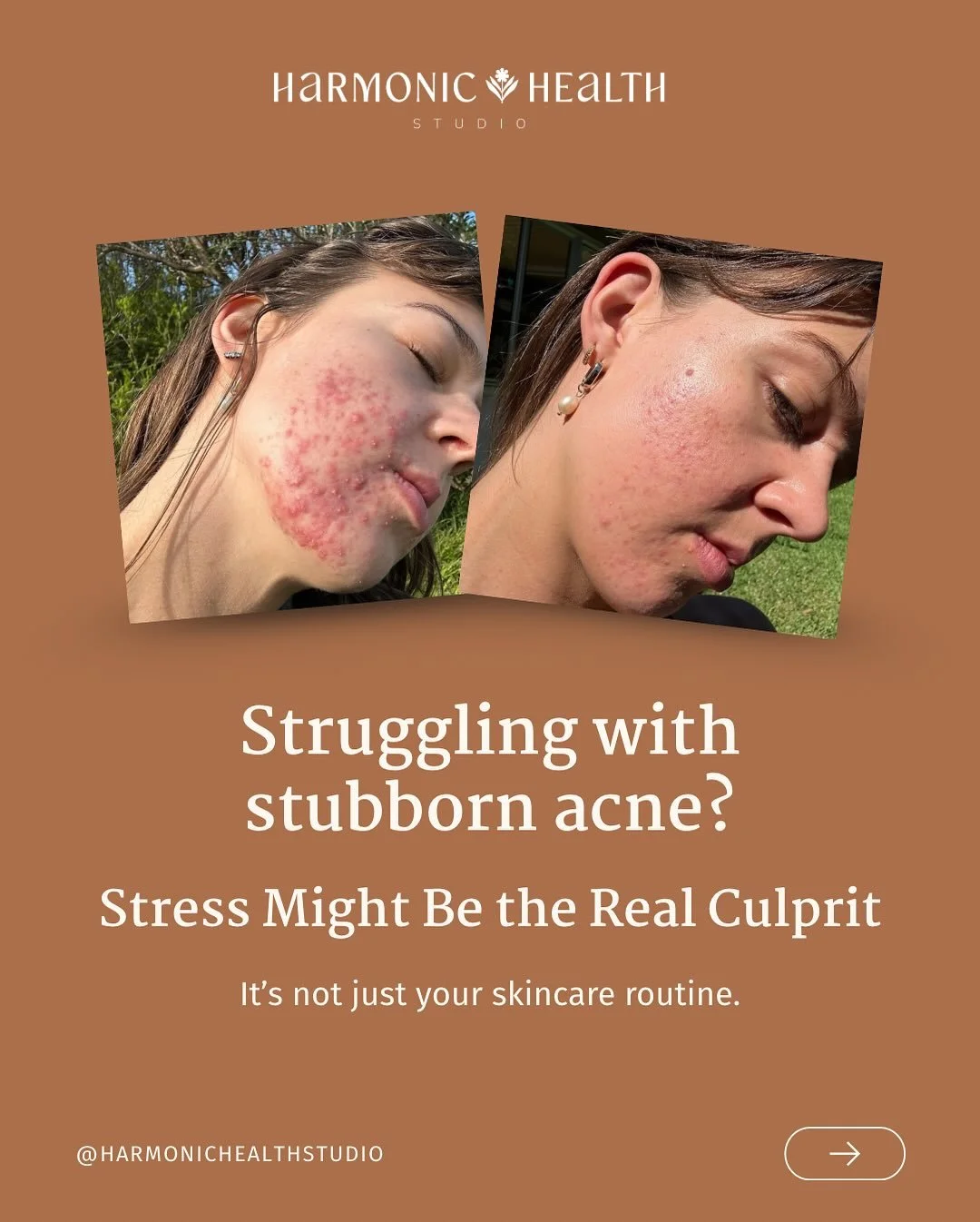 STRESS 

The big driver behind your acne?

Yes, there are always other contributors but if we don&rsquo;t address your stress load we find clearing acne challenging. 

We don&rsquo;t just tell our clients to stop stressing 🙃 

👉🏻We work closely wi