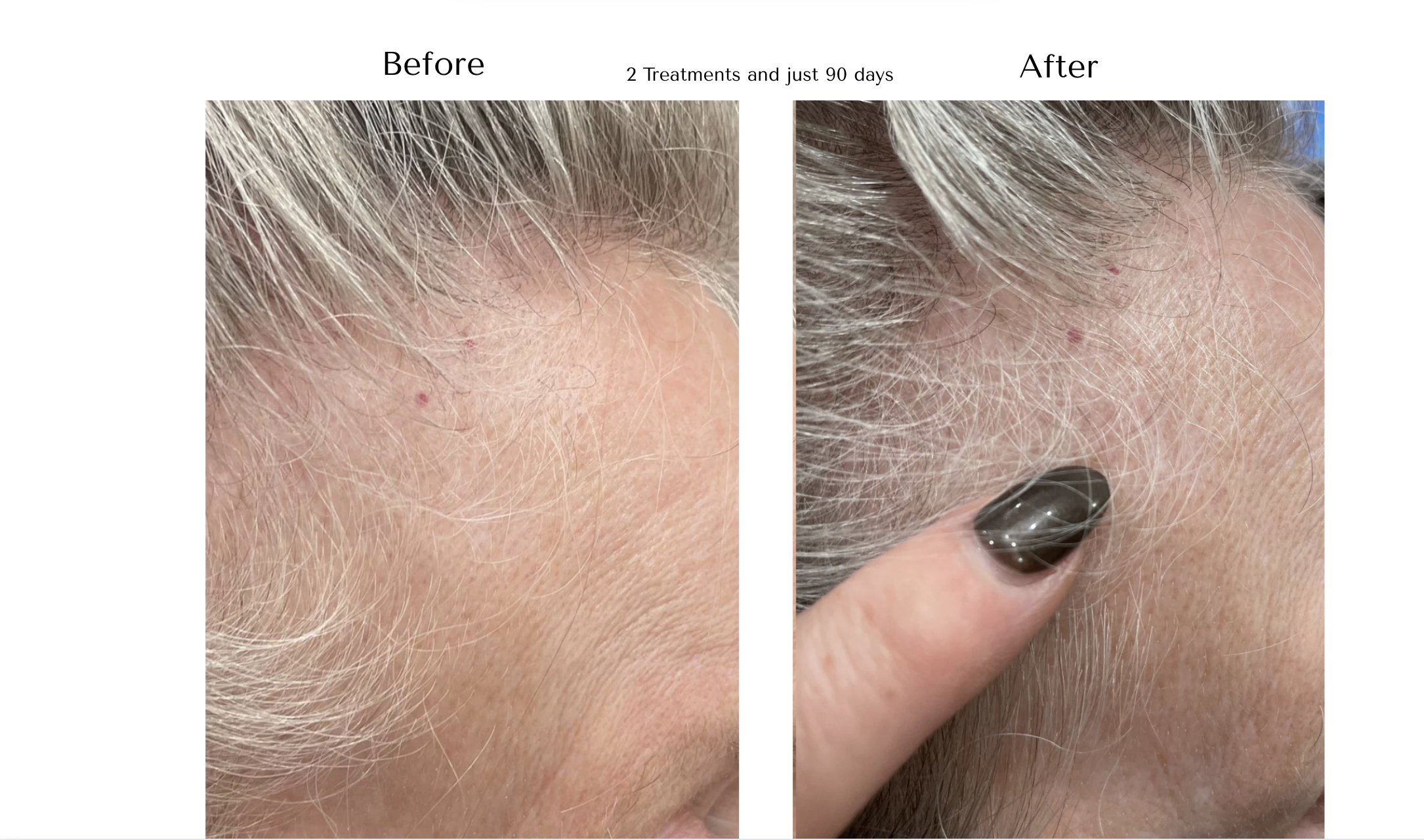 Comparison of forehead hair growth before and after two Alma TED Hair Restorations treatments, showing increased hair follicles, from Suzi Loves Hair Root Revival Salon.
