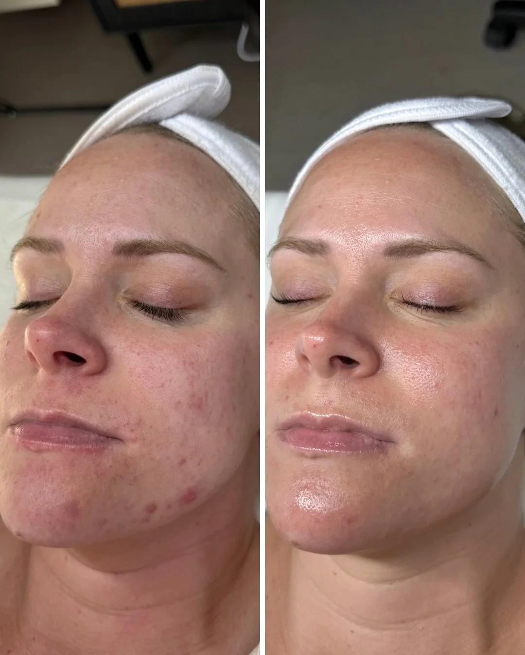This is what dedication + consistency looks like!

This beauty has been doing my Acne Bootcamp for 5 months, staying consistent with her homecare and committing to monthly Acne HydraFacials. Her skin has completely transformed and I&rsquo;m SO proud 