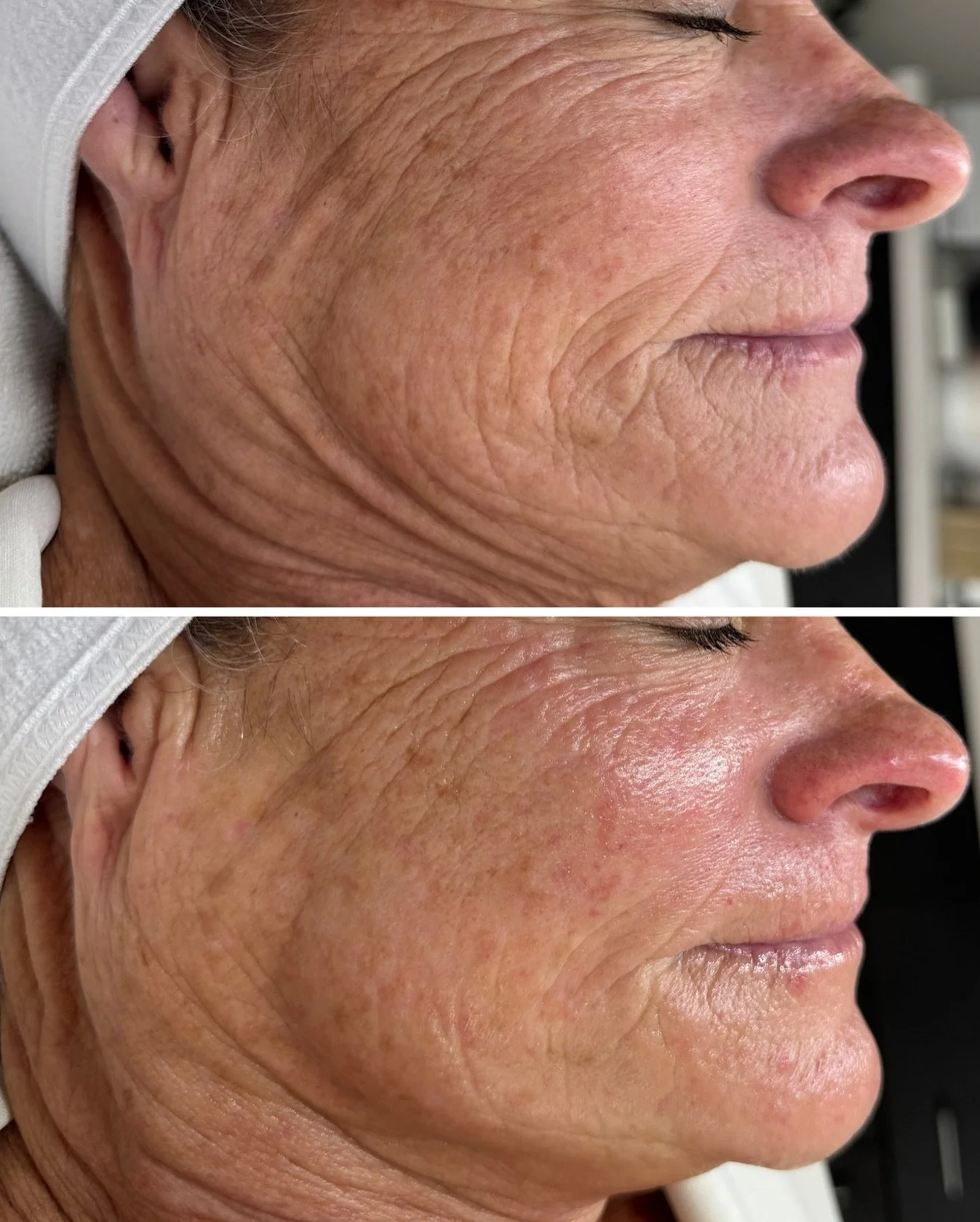 This is the magic of a Platinum HydraFacial + my new HydraFillic Peptide Anti-Aging Booster &mdash; and the results speak for themselves!

✔️Fine lines + wrinkles softened 

✔️Skin looks plumper + more hydrated 

✔️Texture is smoothed + that lit-from