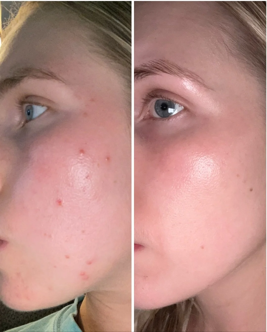Proof that the right products, patience, and consistency truly make all the difference! These results were achieved with products and lifestyle changes only! 

Your daily routine will always do more than a facial every few months. 80% of your results