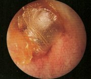 Perforated-Ear-Drum.jpg