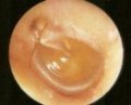 Glue-Ear-Hearing-Loss-Tolbecs-Ear-Clinic-Waikato-Hamilton.jpg