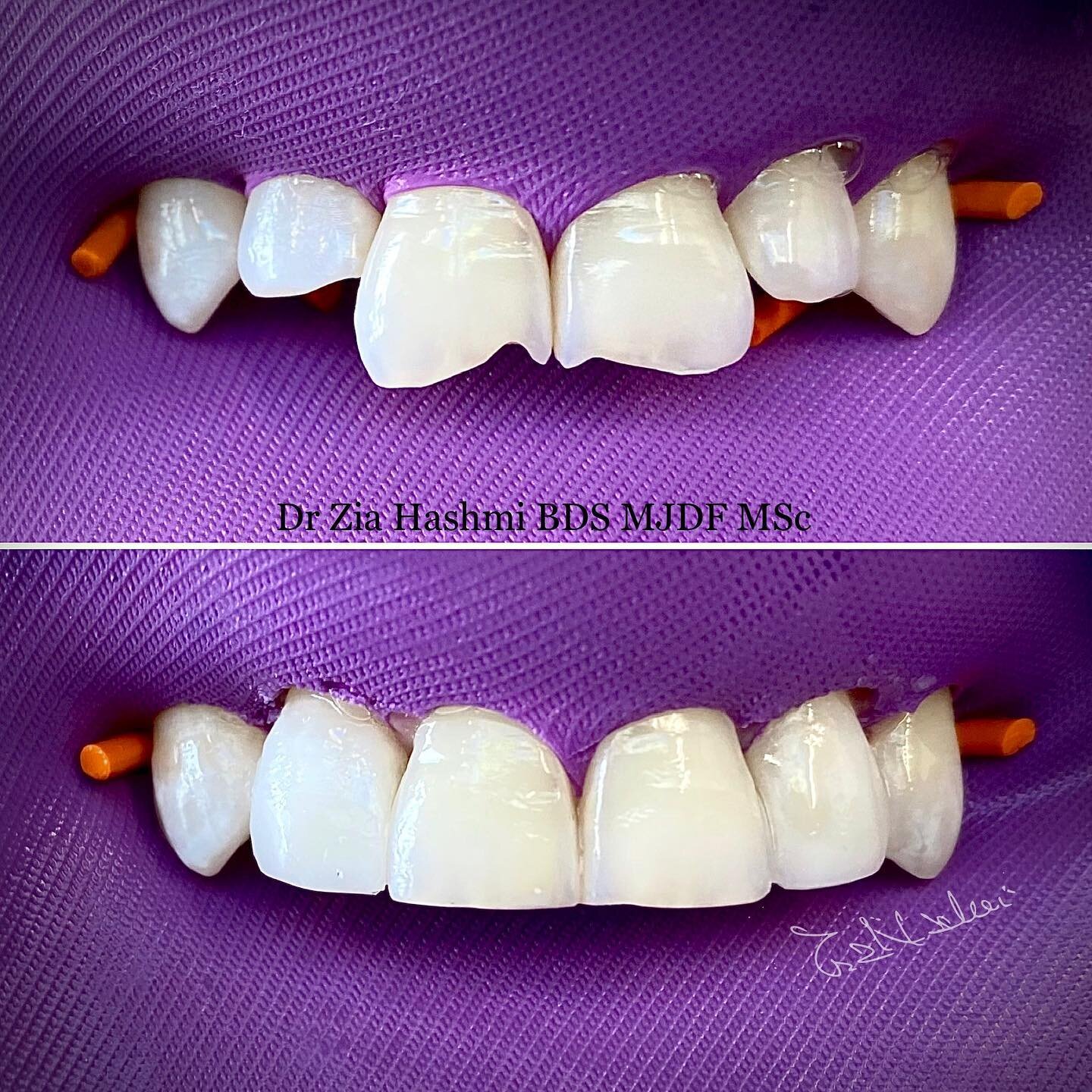 Damage repair- composite bonding upper front 4 #restorativedentistry