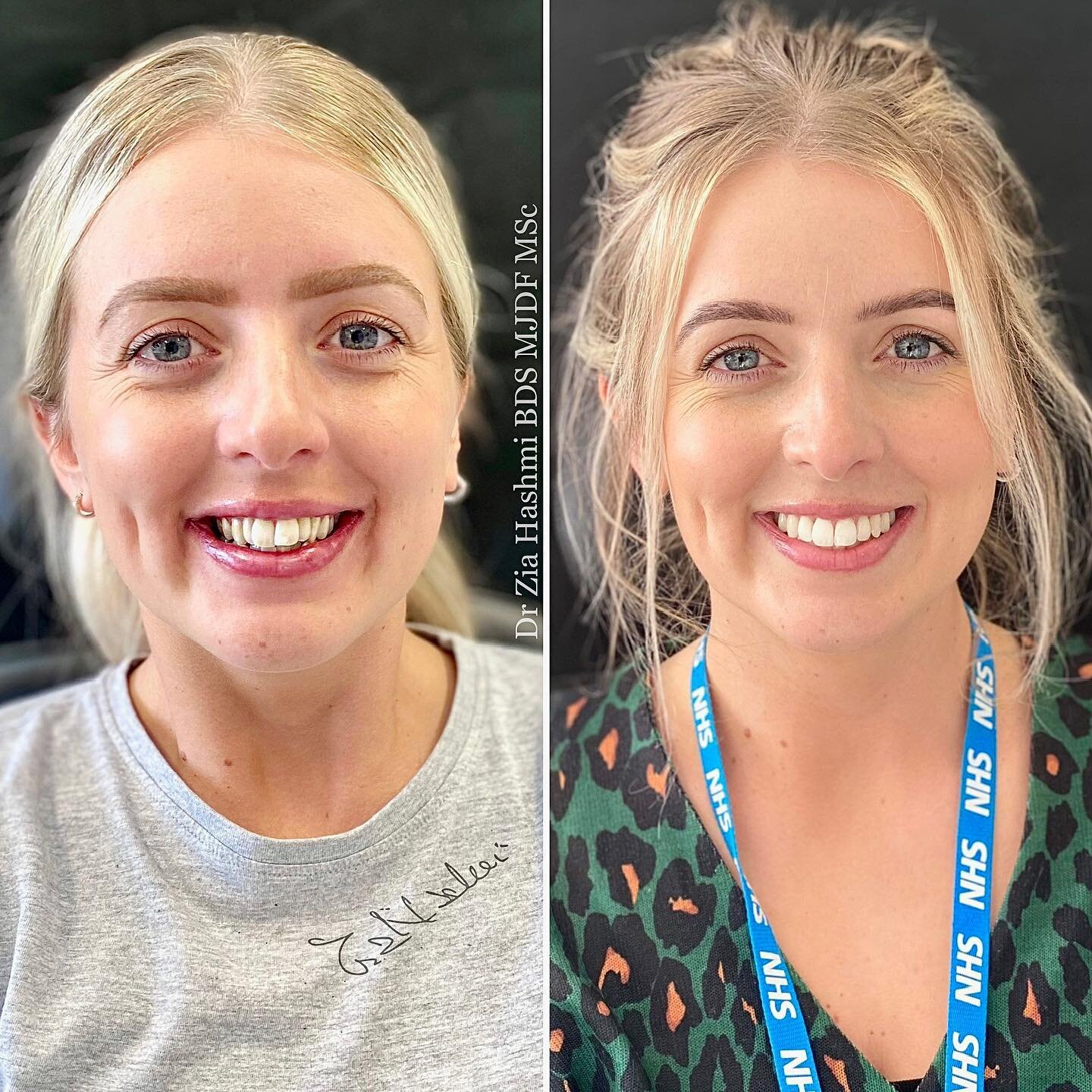 Invisalign transformation ☺️ #invisaligntransformation #smiletransformation #invisalignbeforeandafter #invisalignuk