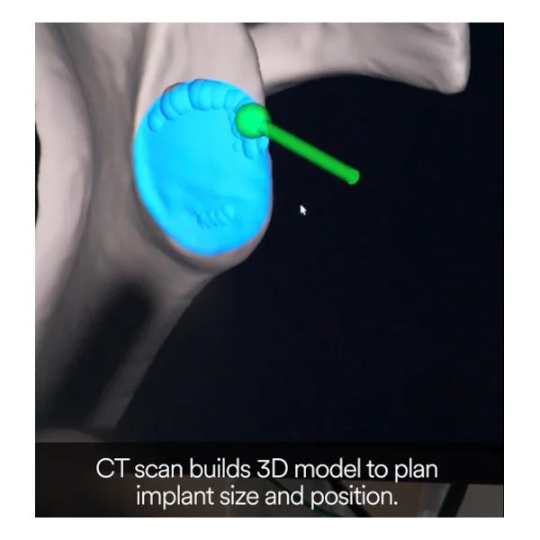 Need shoulder surgery? The robot will see you now at this Lakewood hospital - tnt