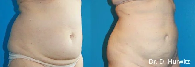BodyTite Liposuction Results in San Antonio
