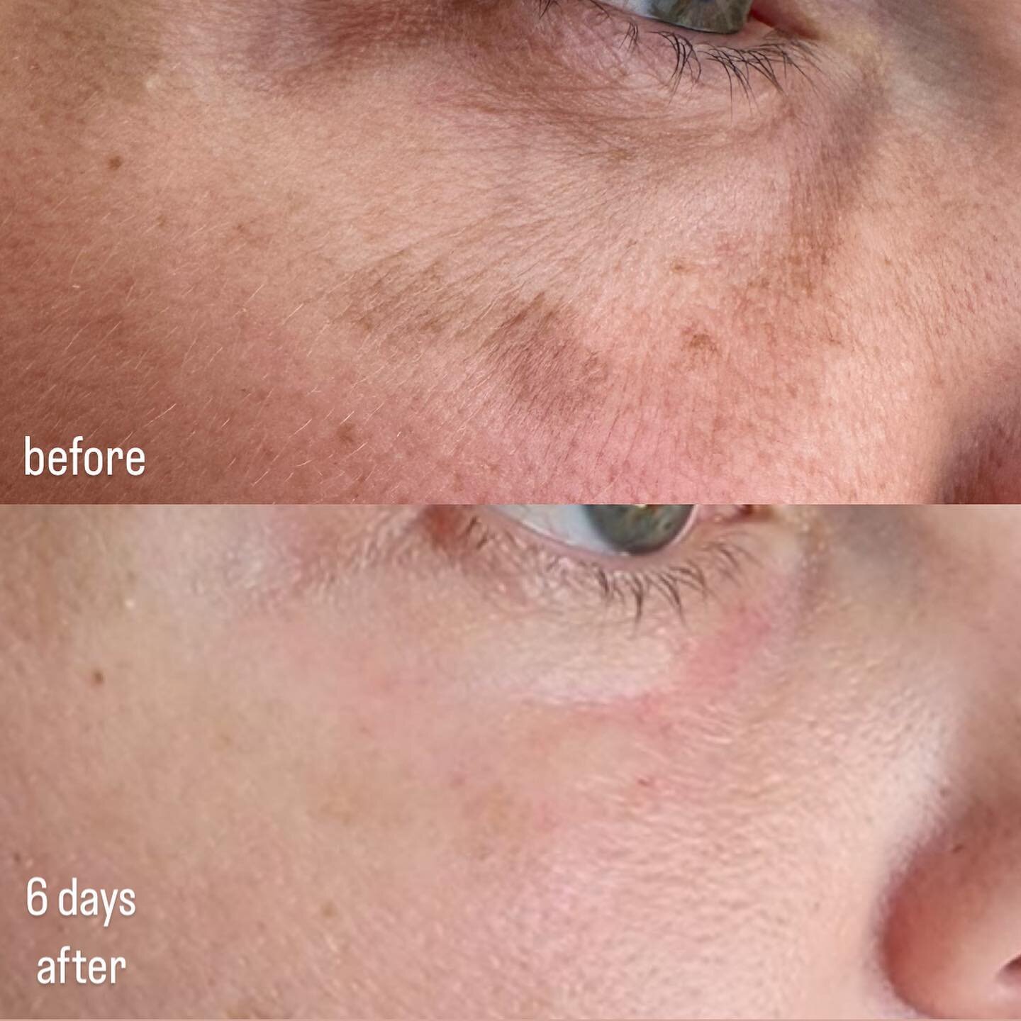 Two birds, one stone.  Plasma fibroblast for the win again!  Lines and pigmentation handled with one treatment.  Dm me to book your appointment!