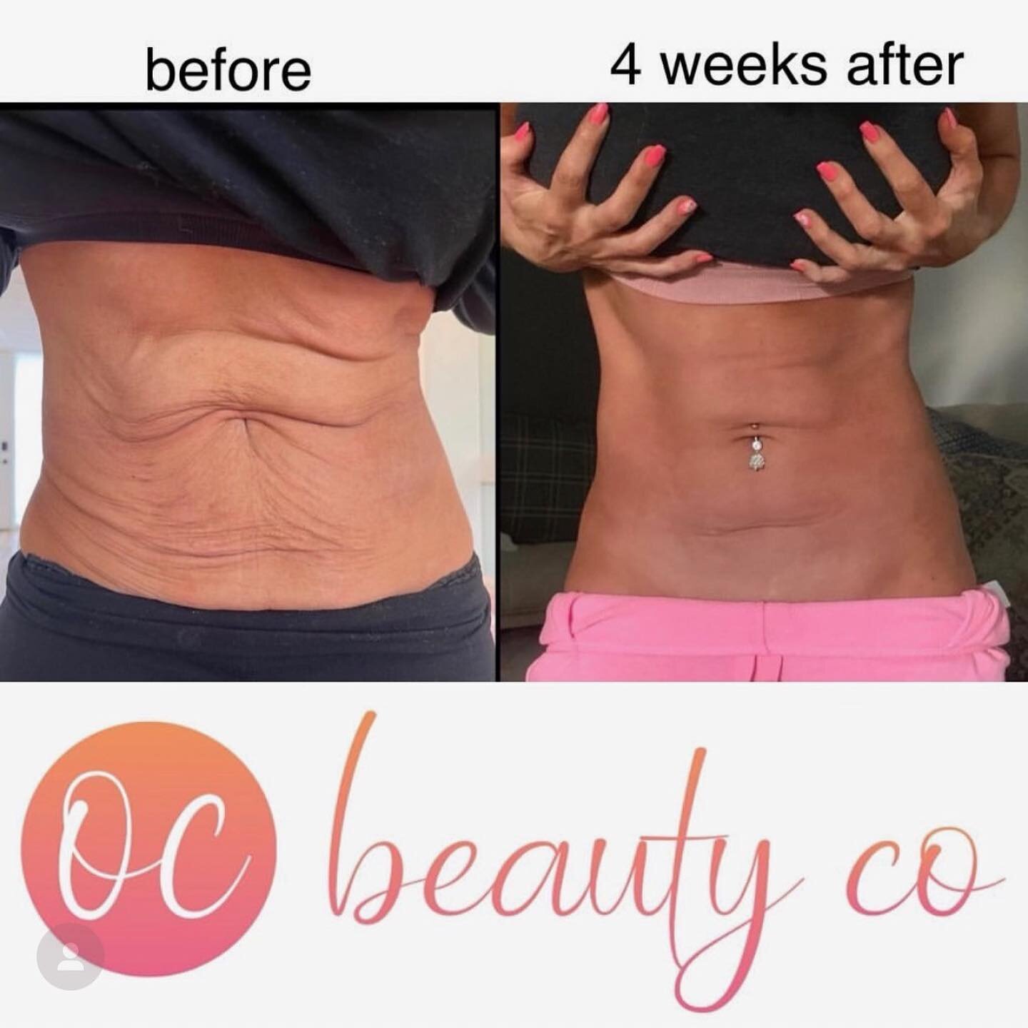 Get your skin stage ready at 👉 @ocbeautyco! Sometimes the skin doesn&rsquo;t always follow your muscles when getting tight. Let @ocbeautyco help get you ready with some amazing skin tightening! Swipe right to see the stages of this amazing transform
