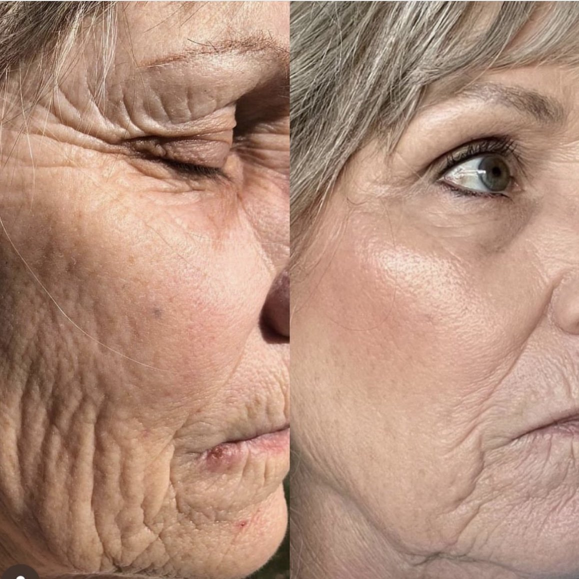 Skin Tightening Plasma Fibroblast  Rejuvenate & Shrink Your Skin — OC  BEAUTY CO Permanent Makeup & Skin Treatments