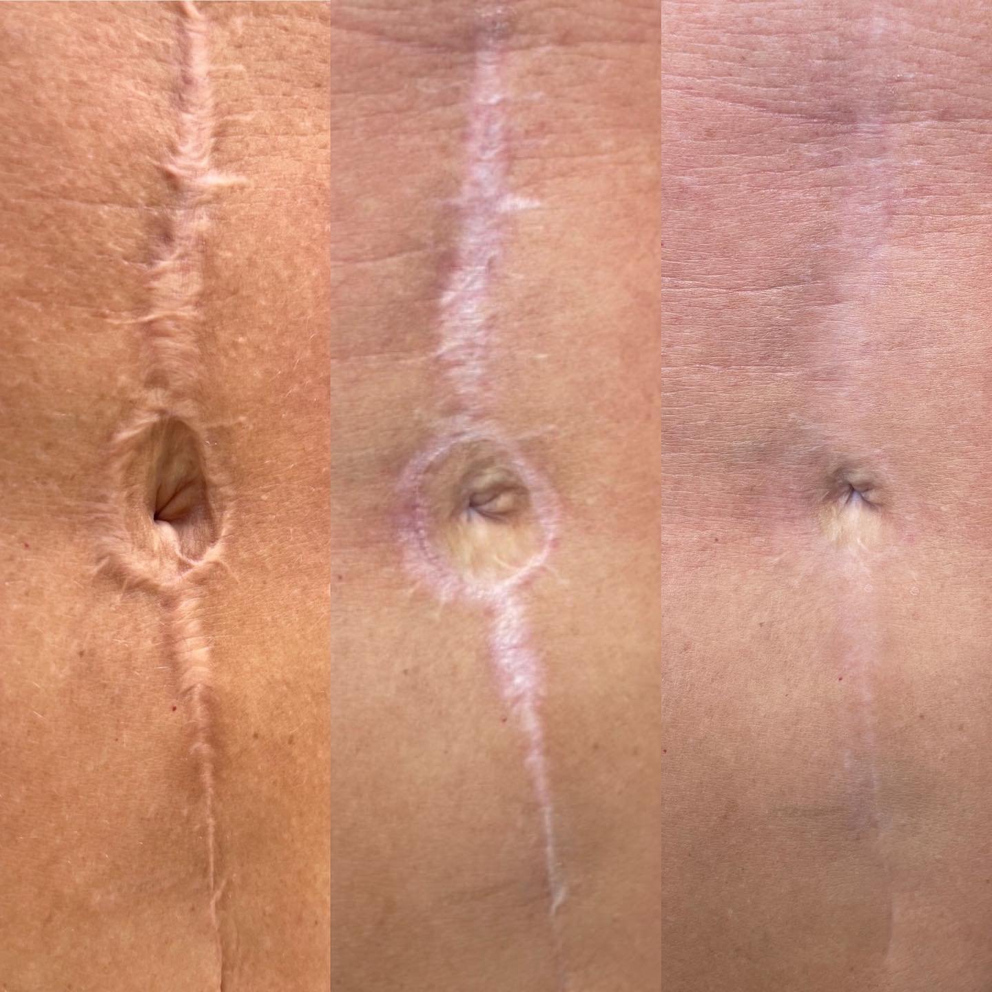 Surgical Mark Camouflage | Scar Camouflage Treatments