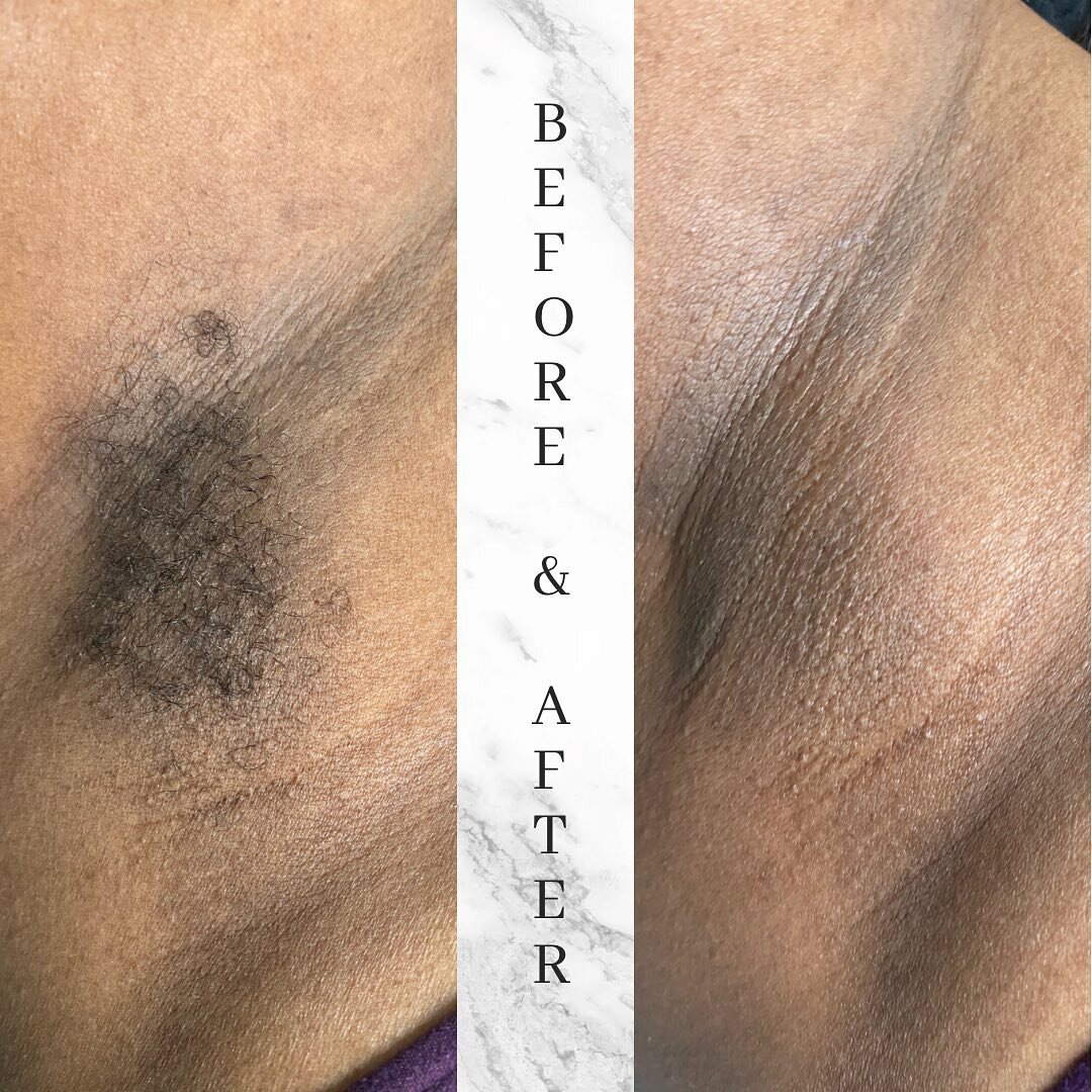 β¨Ready to bare it all? Our underarm waxing service will leave you feeling confident and silky smooth. Book now!β¨