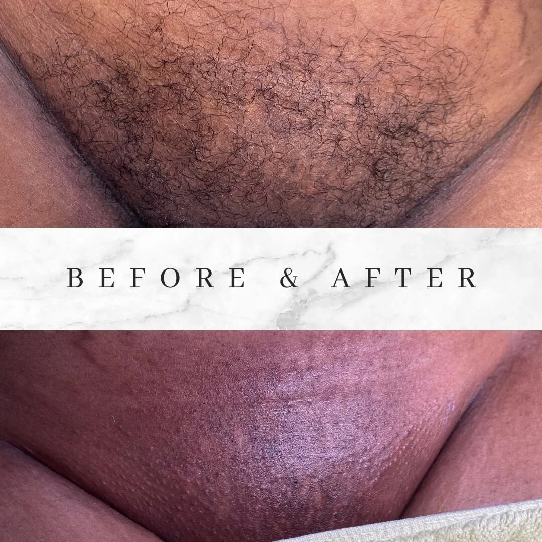 β¨ Bare it all with confidence thanks to our bikini waxingβ¨