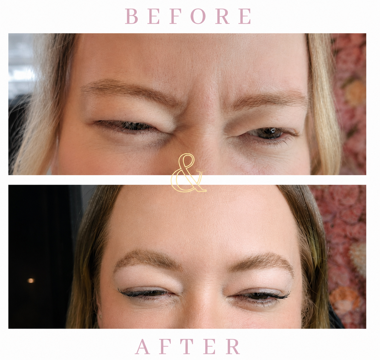 How Much Does Botox Cost in Waterloo? (2026 Pricing Guide)