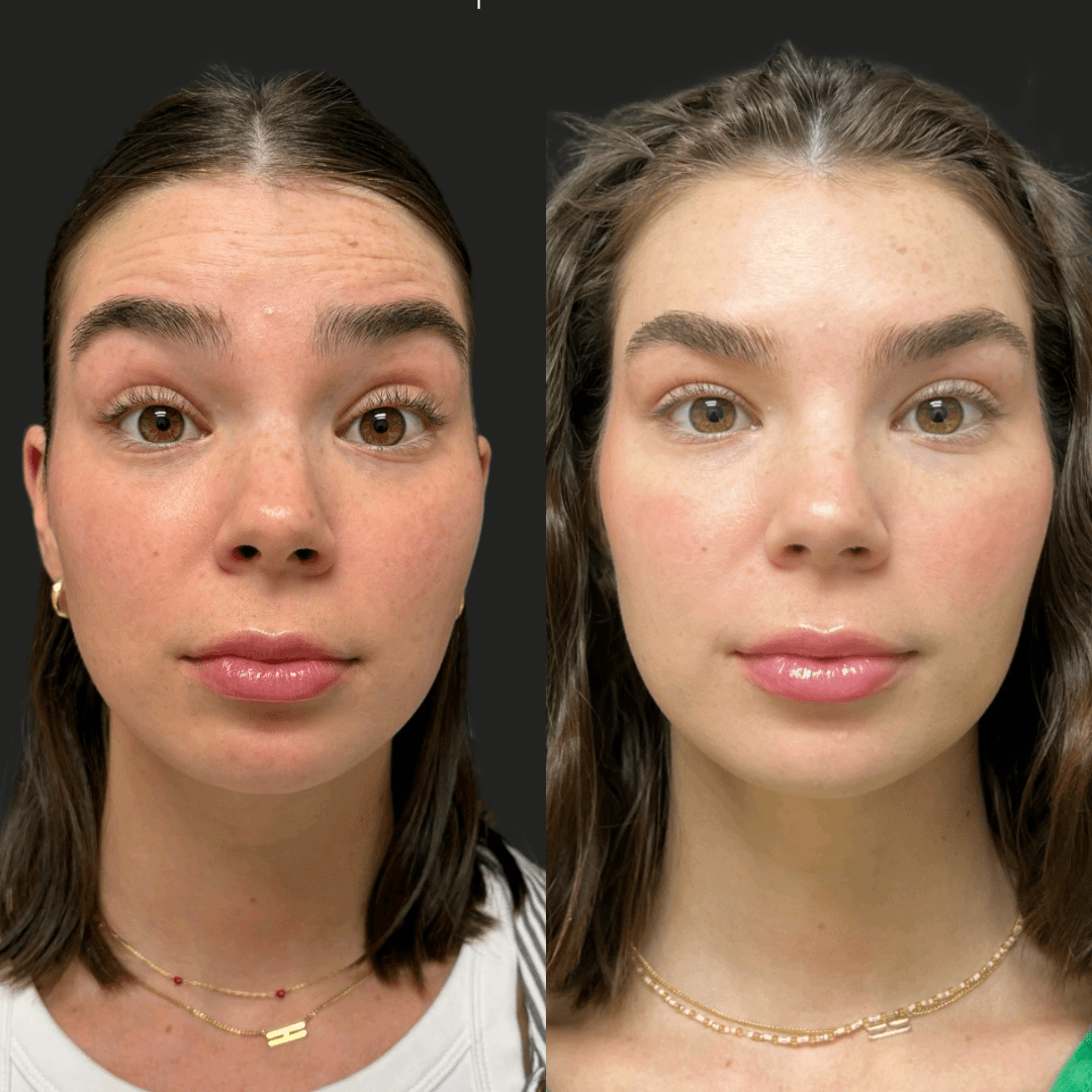 Botox results forehead Waterloo before and after Luna Aesthetics