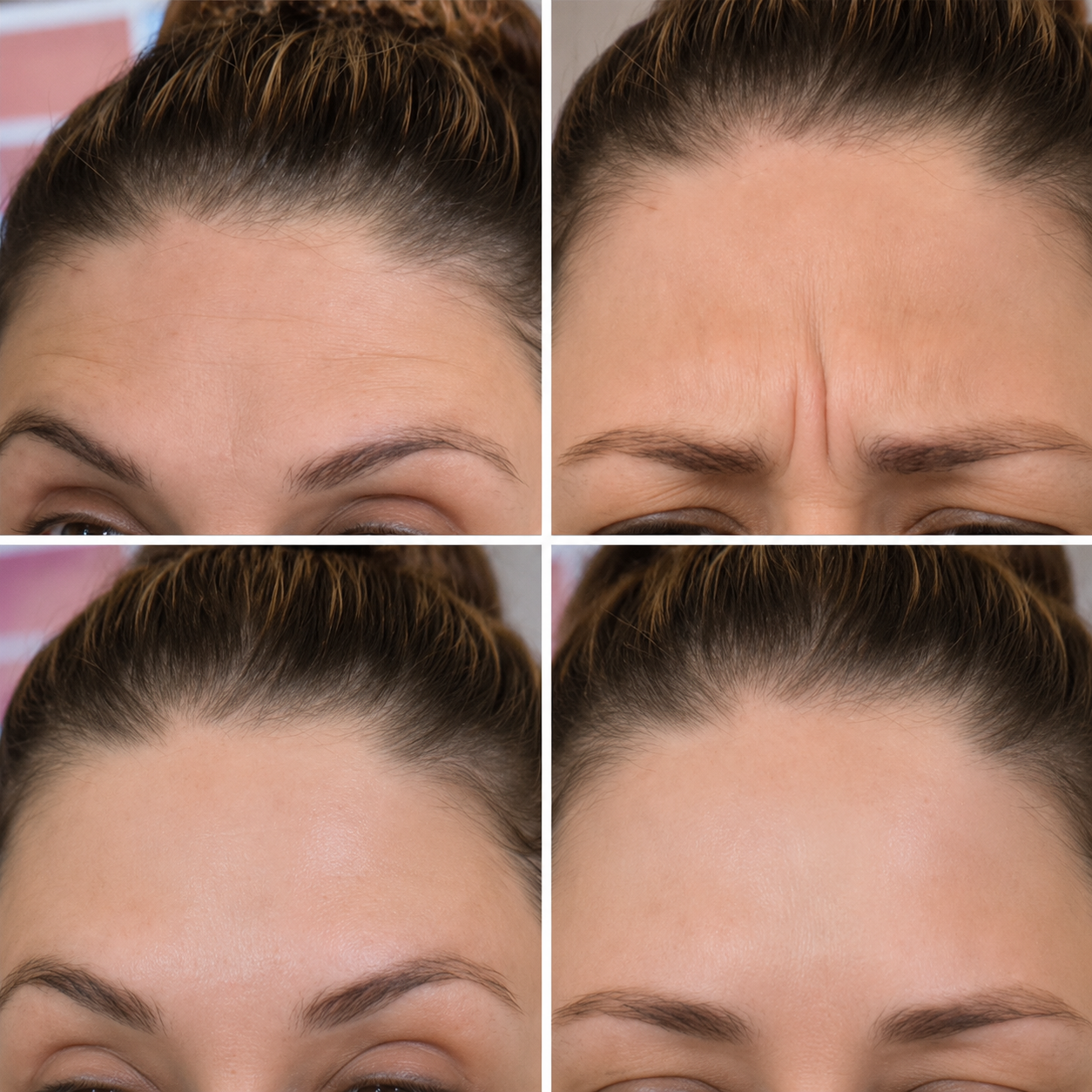 Botox Kitchener results before and after Luna Aesthetics Waterloo