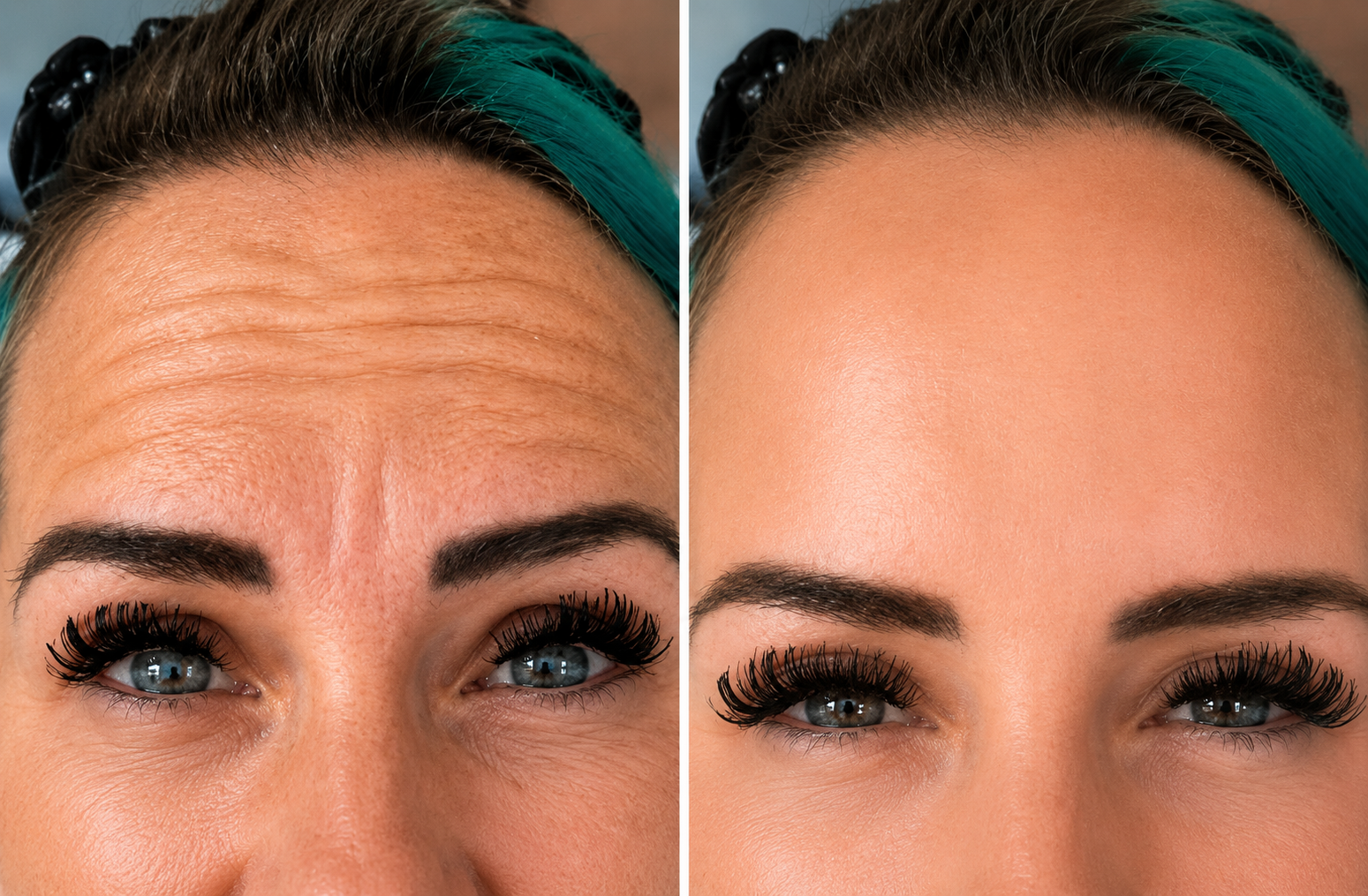 best Botox results Kitchener before and after Luna Aesthetics