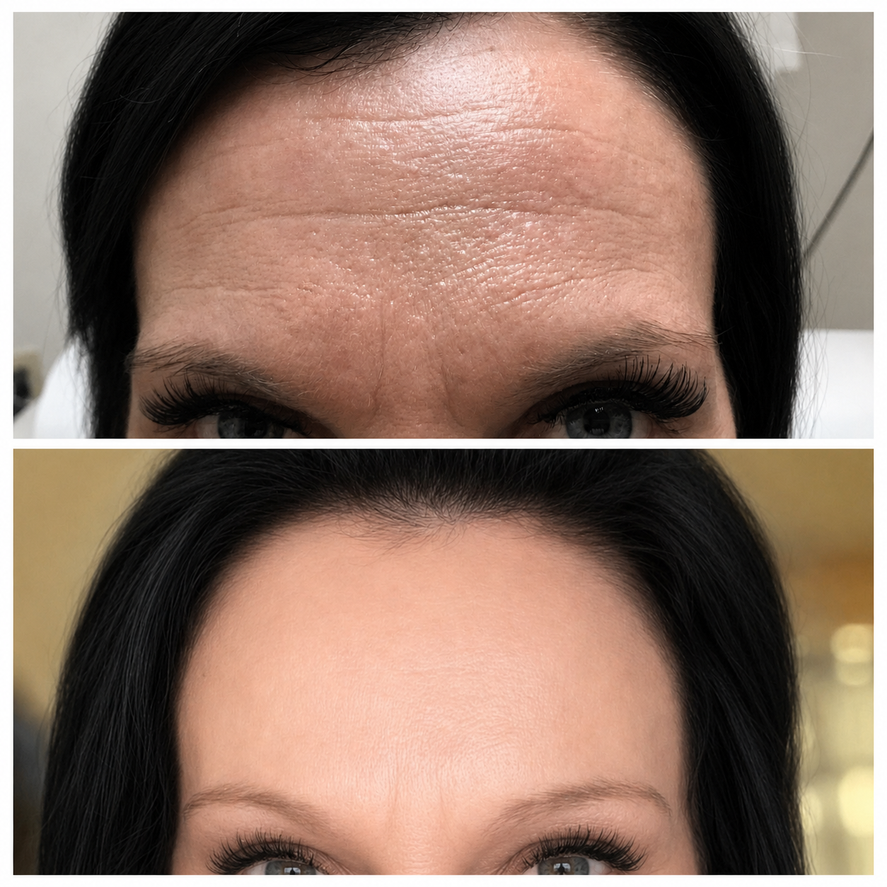 best Botox Kitchener first timer result before and after Luna