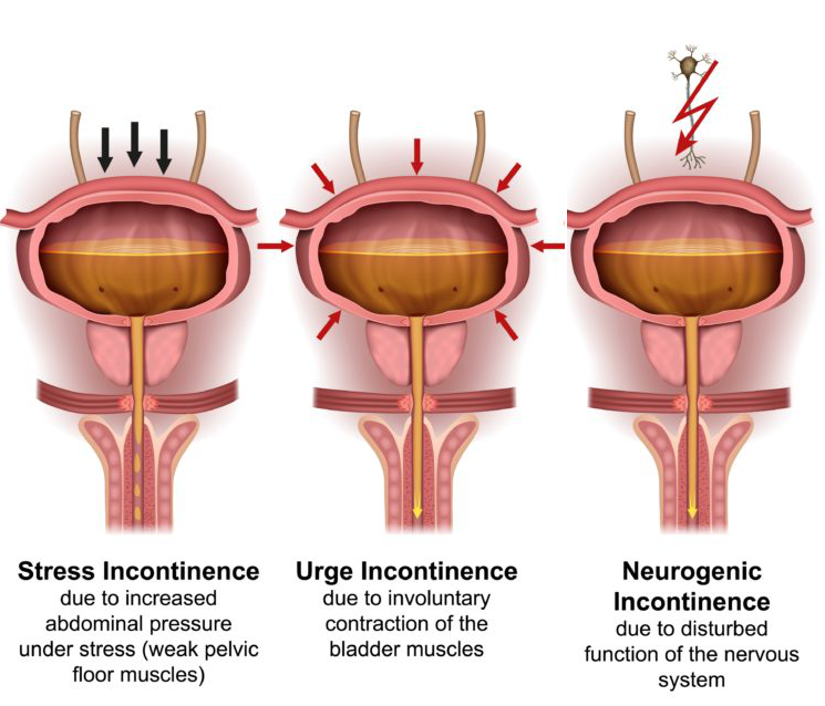 Incontinence & Urge Frequency — PhysioMotion Hong Kong