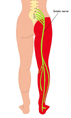 Sciatica: Beyond the Pain, Finding the Cause