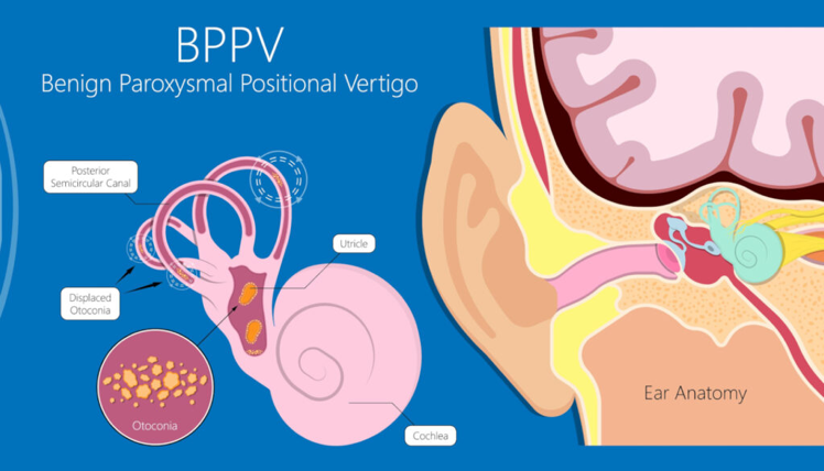 Benign Paroxysmal Positional Vertigo (BPPV)When Your World Spins