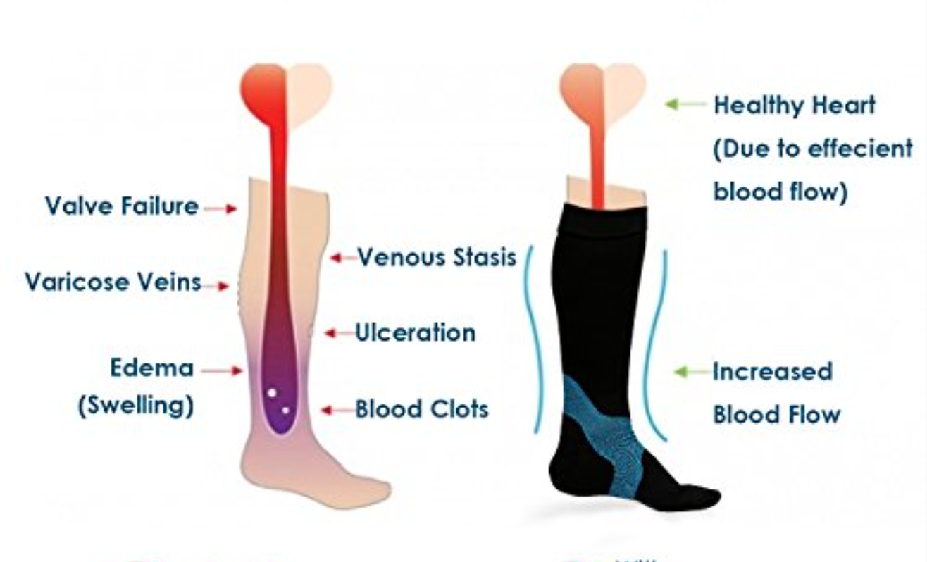 PhysioMotion Central Hong Kong Physical Therapy Lymphedema Management