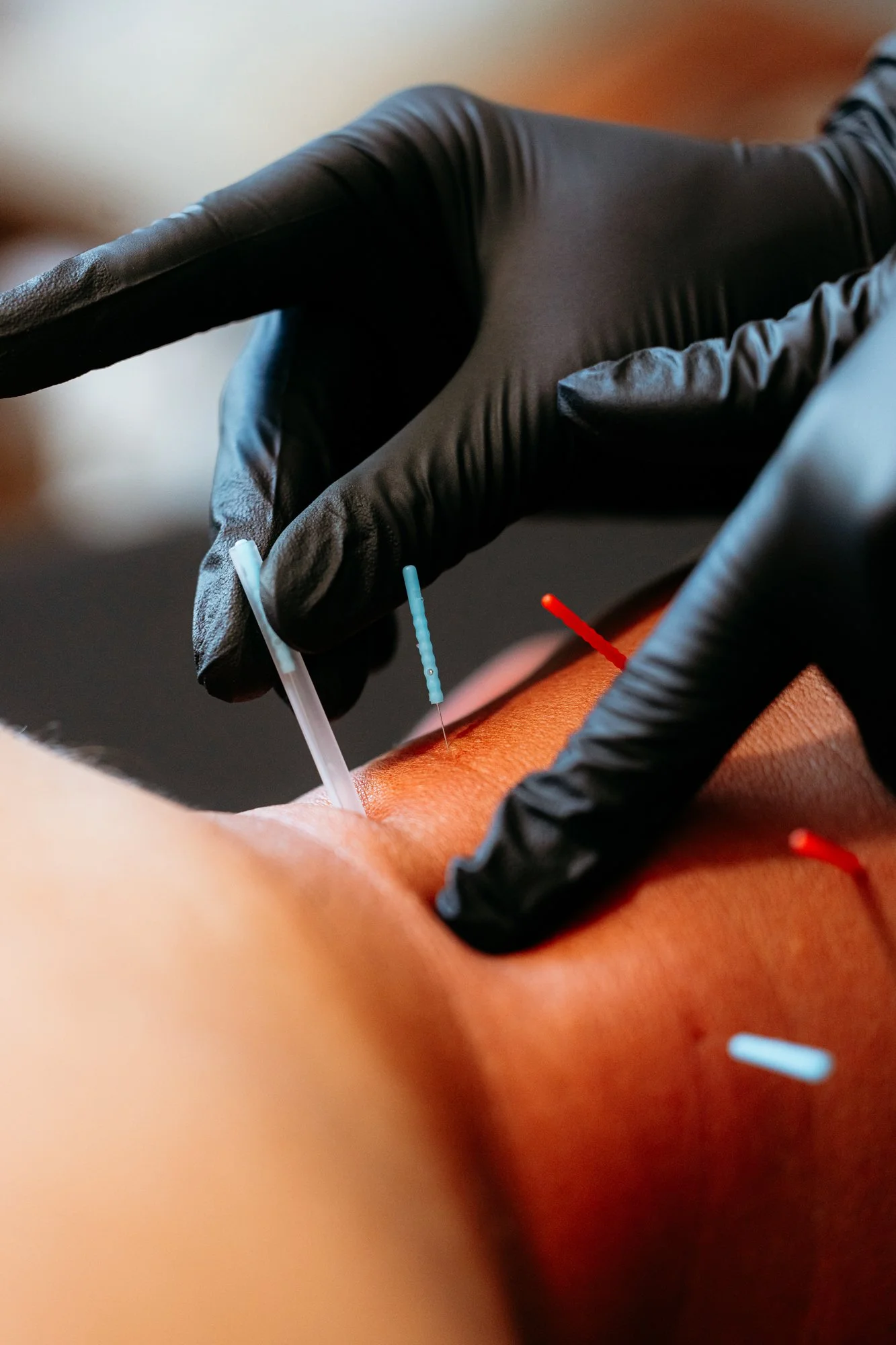 how-long-does-dry-needling-last
