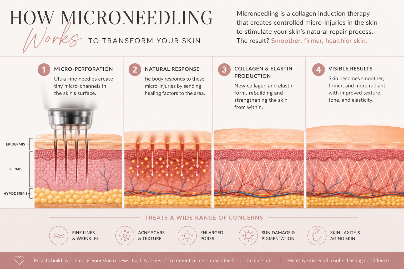 Microneedling in Palm Harbor: Is It Worth It for Fine Lines, Acne Scars, and Aging Skin?