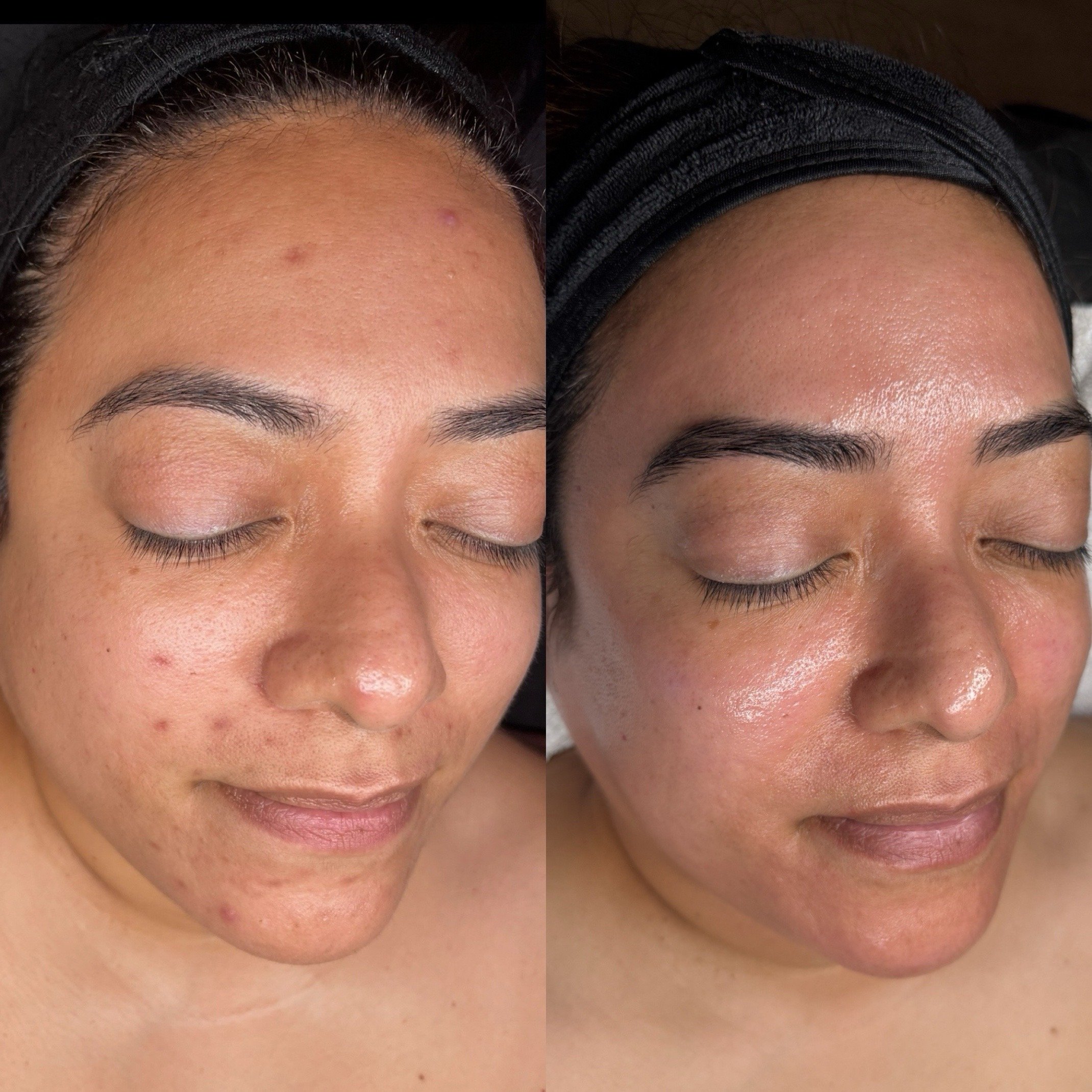 Why Consistency Matters More Than One “Perfect” Treatment