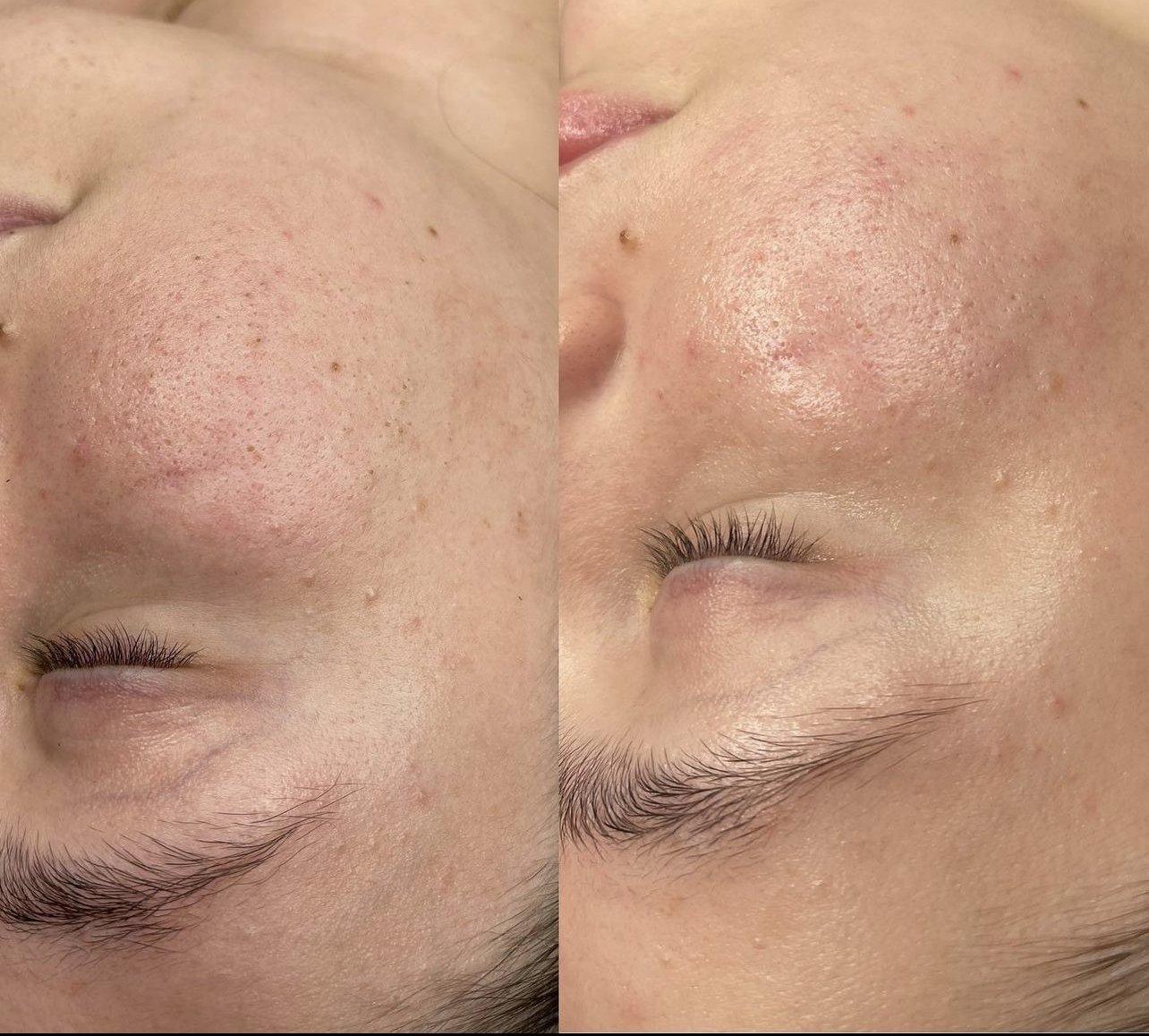 Acne Clear Skin Facial with Extractions