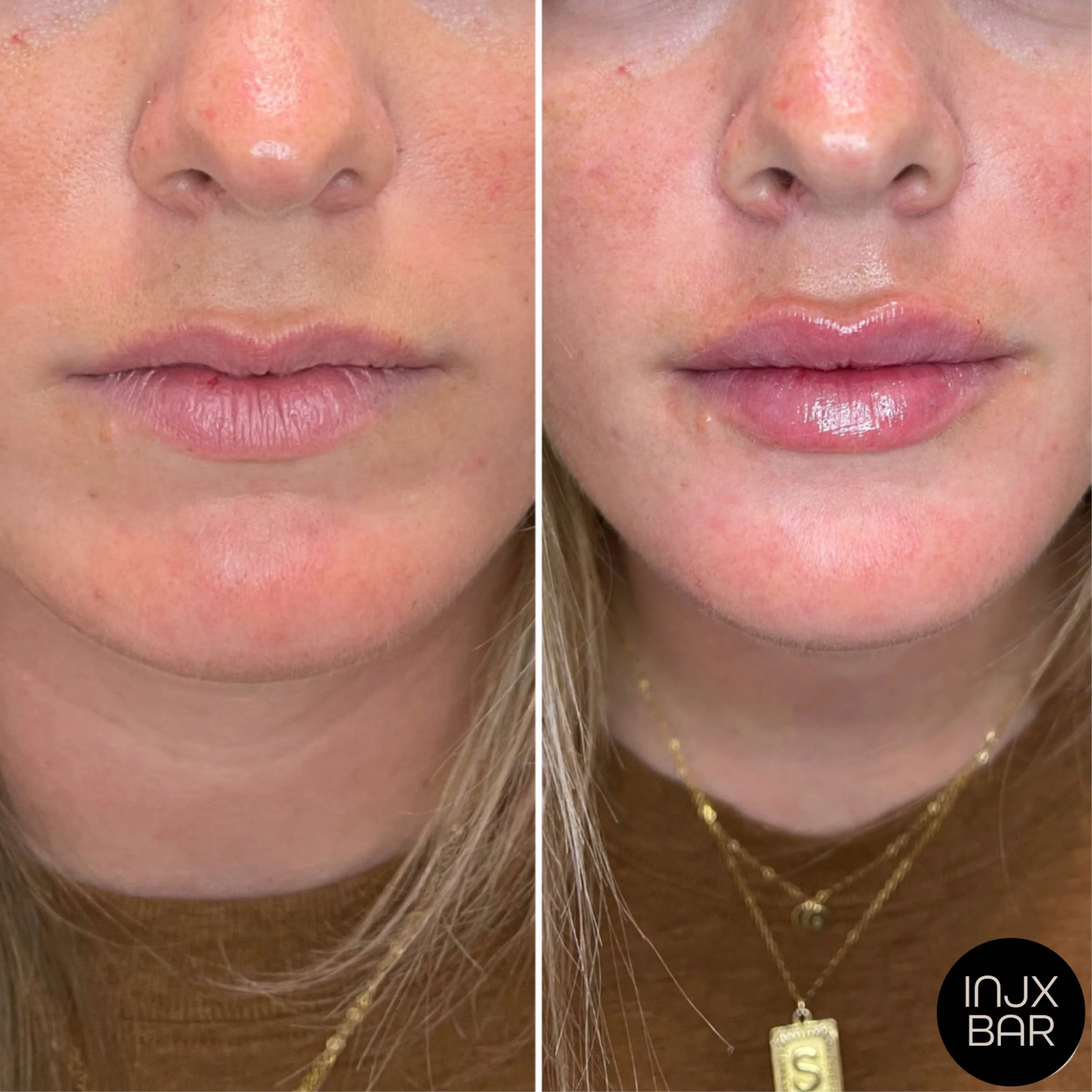 lip-filler-treatment.jpg