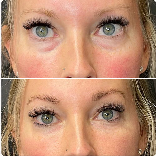  Before and After Under Eye Filler 