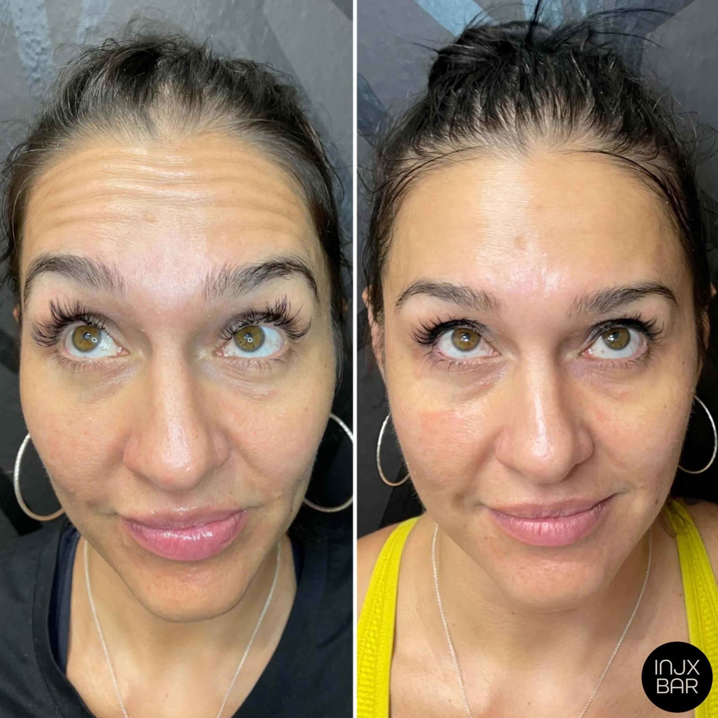 Before and 2 weeks after Neuromodulator treatment for forehead lines