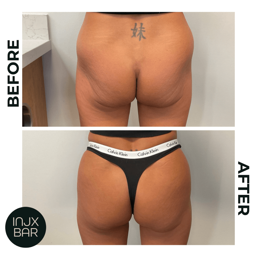  Non-surgical BBL using Hyper-Dilute Radiesse    