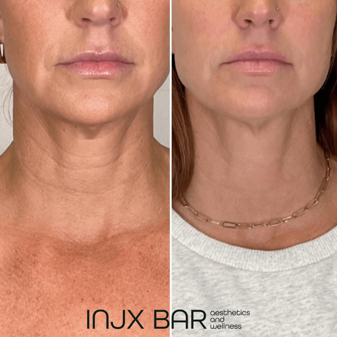  Neck lines AKA "tech neck" treatment with Belotero    
